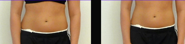 Medical Weight Loss Programs Springfield TN Before and After Waist Medical Weight Loss Programs Springfield TN Before and After Waist